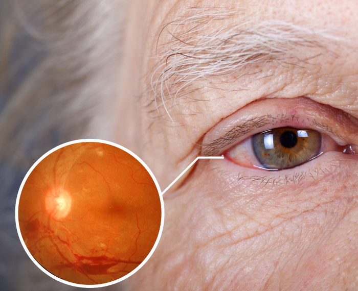 Diyabetik retinopati görseli